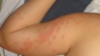 Rote Flecken am Körper, Armen und Beinen